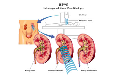 kidney stones