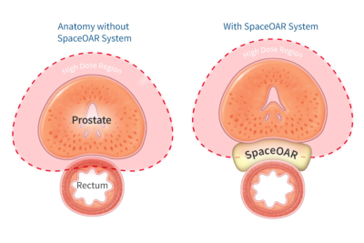 SpaceOAR hydrogel pushes the rectum out of the damaging radiation field